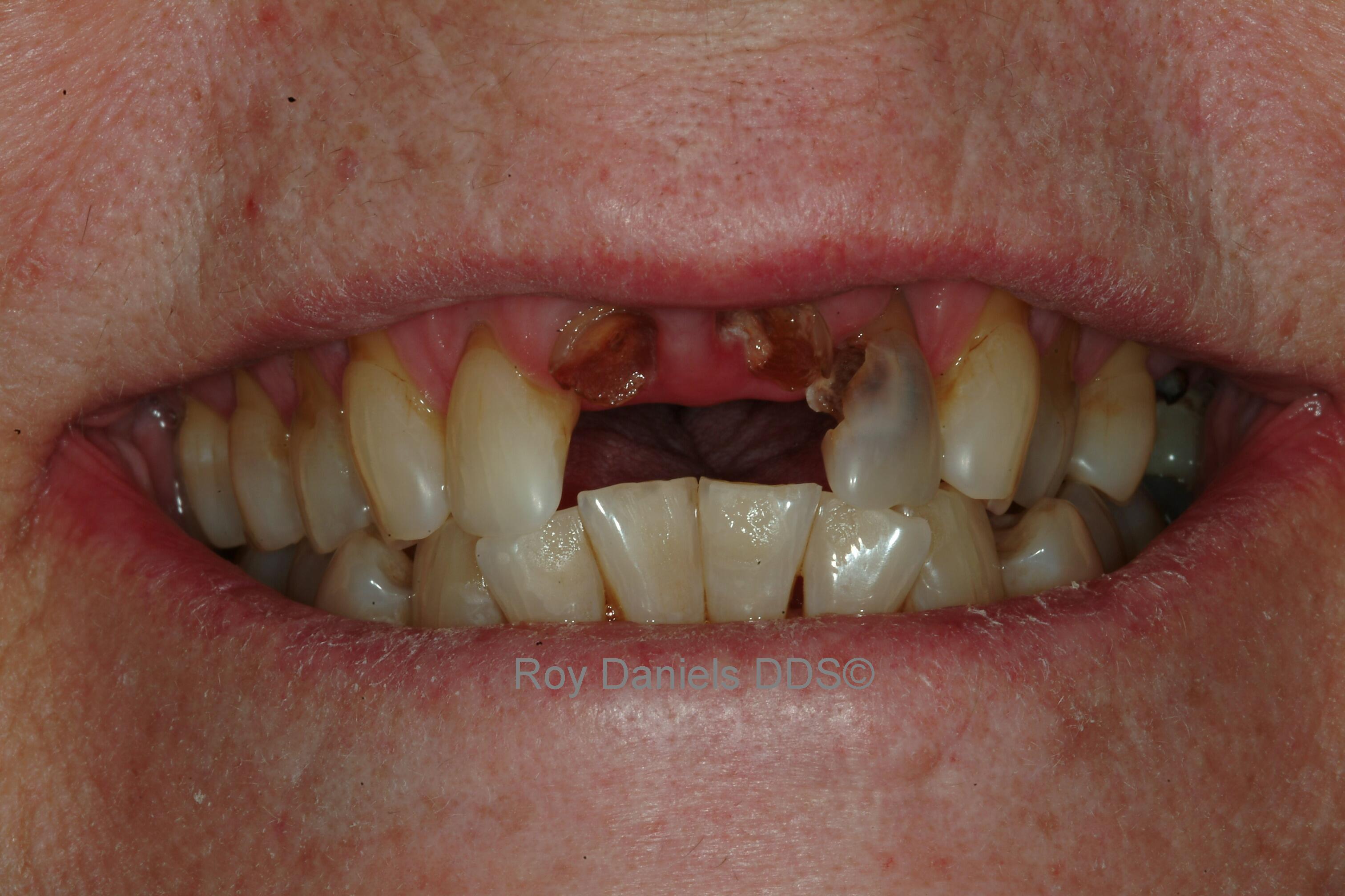  dental bridge front teeth uk