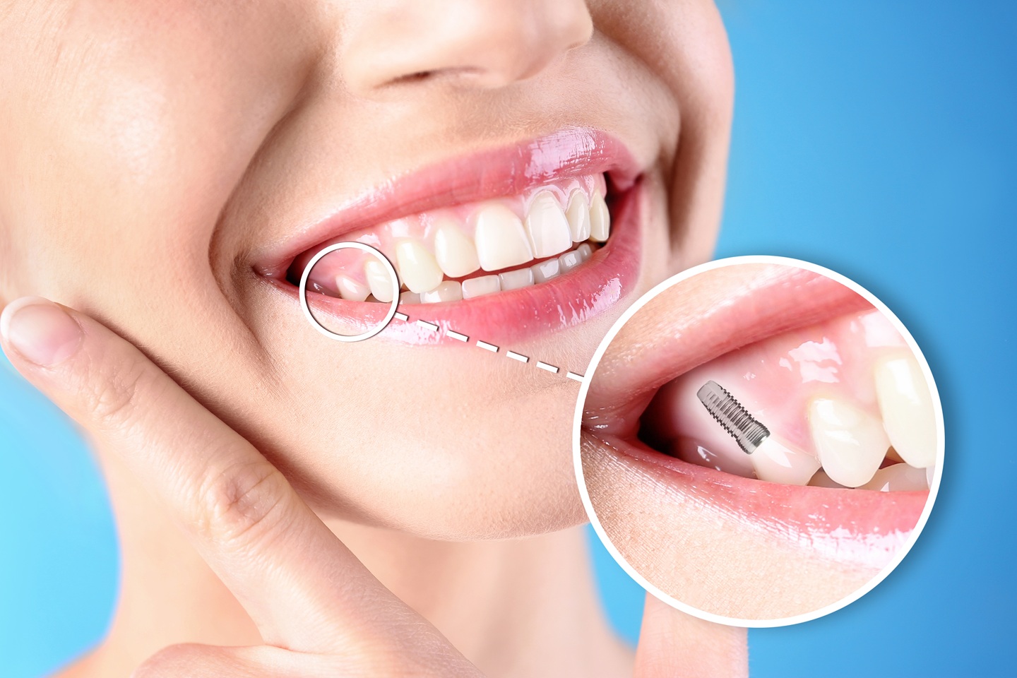 Dental Implants vs Other Tooth Replacements Dental Implants vs Other Tooth Replacements