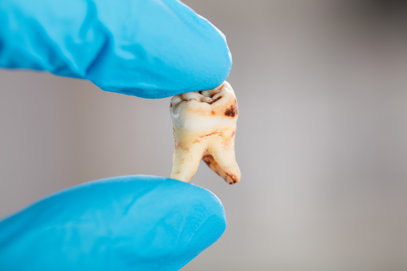 What to Expect During a Tooth Extraction What to Expect During a Tooth Extraction