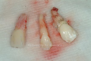 Dental Emergency Trauma Avulsed Permanent Teeth