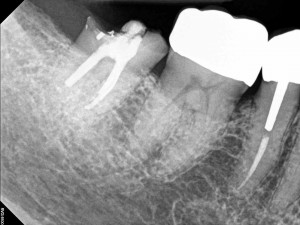 recement dental crown xray 
