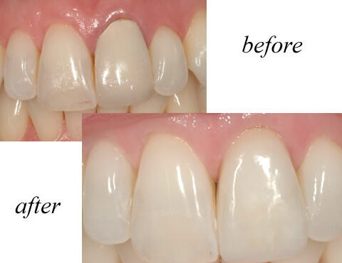 how to get rid of black line above crown, black gum line around tooth treatment, gum turning black around crown